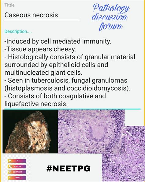 Coagulative Necrosis Pathology Hematology Mediation