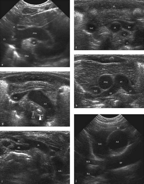 Tracheoesophageal Fistula Ultrasound