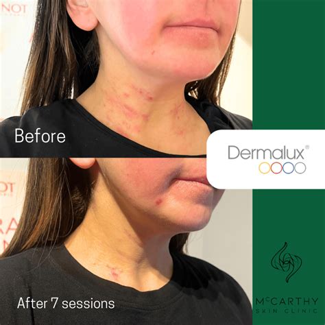 Dermalux Led Phototherapy Milton Keynes
