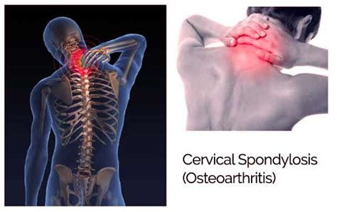 Cervical Osteoarthritis