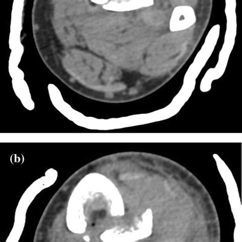 Computed Tomography Axial Image Of An Open Tibial Shaft Fracture