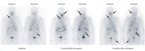 Radioactive Iodine Scan