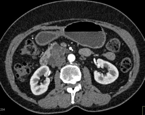 Serous Cystadenoma Head Of Pancreas With Dilated Common Bile Duct