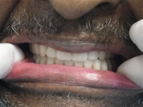 Dentures And Partials Brookline Dentist Brookline Village Dental