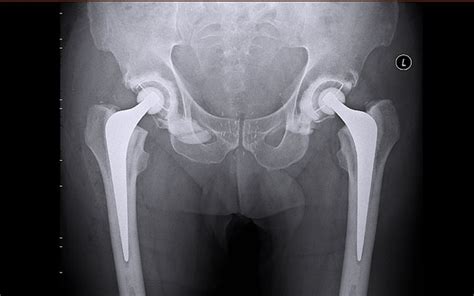 Better Sex After Hip Surgery The New York Times