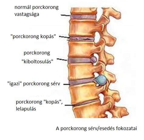 Nyaki gerincsérv és tünetei Dr ORMOS GÁBOR PhD