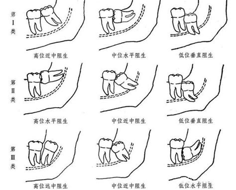 拔智齿为什么下牙比上牙贵因为下颌智齿拔起来更复杂一些牙齿修复 8682整形网