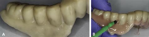 Figure 1 From Creating Durable And Esthetic Gingival Anatomy On A