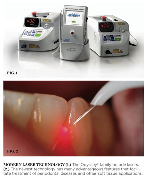 Periodontal Applications Of The Diode Laser February 2010 Inside