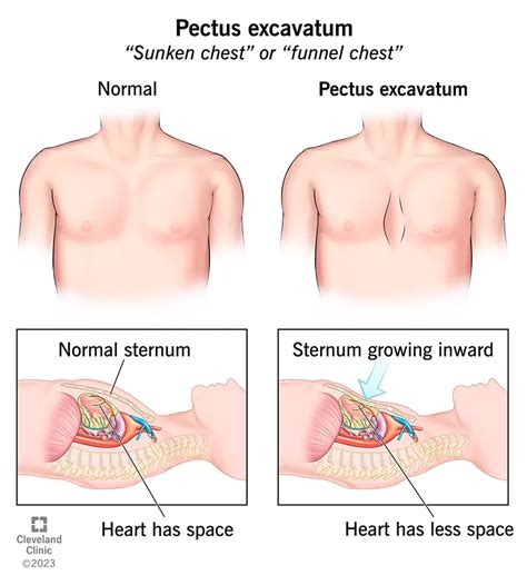 Pectus Excavatum Sümptomid Põhjused Ja Ravi SFOMC