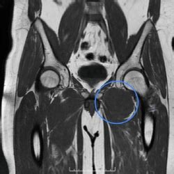 Sarcoma Sinovial Ortopedia Oncológica Especialista em SP