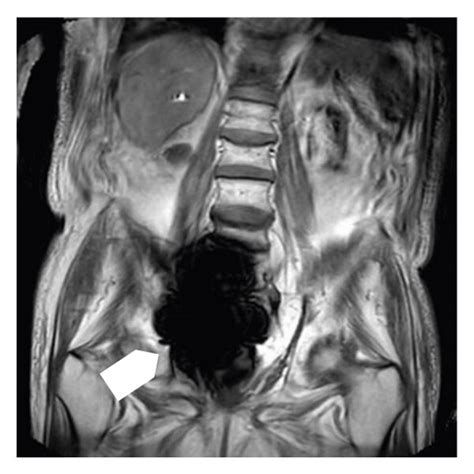 A Coronal Fast Spin Echo T And B T Weighted Images From An