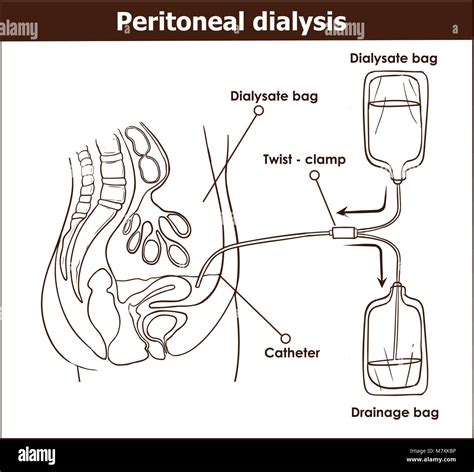 La Diálisis Peritoneal Son Usados Para Tratar La Insuficiencia Renal