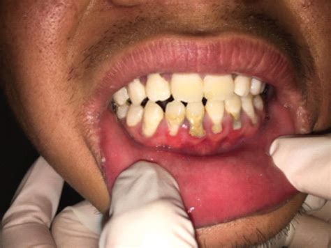 Necrotizing Ulcerative Gingivitis Before And After