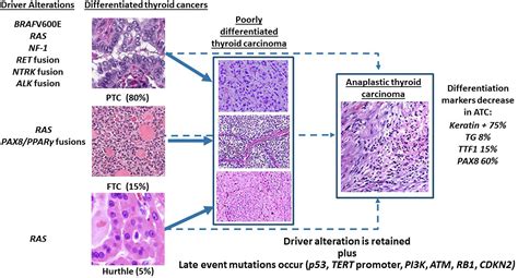 A Decade Of Progress In Targeted Therapy For Advanced Thyroid Cancer