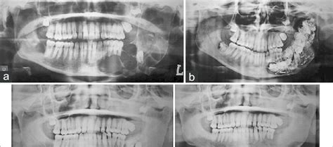 A Preoperative Radiograph B Postoperative Radiograph 3 Months Download Scientific