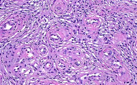 Prostate Stromal Hyperplasia Light Micrograph Stock Image C058