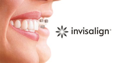 What Are Invisible Braces And How Do They Work Lion Dental Centre