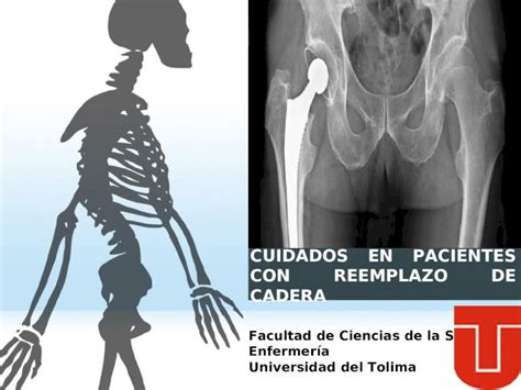 PPT EDUCACIÓN MOVILIZACIÓN DE PACIENTES CON REEMPLAZO TOTAL DE CADERA