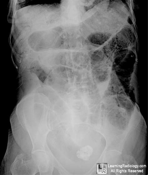 Gallstones Pathogenesis And Treatment