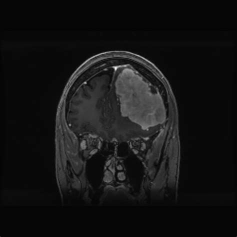 Solitary Fibrous Tumor Hemangiopericytoma Image Radiopaedia Org