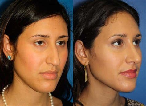 Ethnic Rhinoplasty In New York City Dr Philip Miller