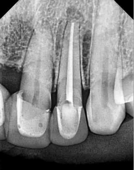 Root Canal Apicoectomy Before After Pictures The Favour Dental Demo