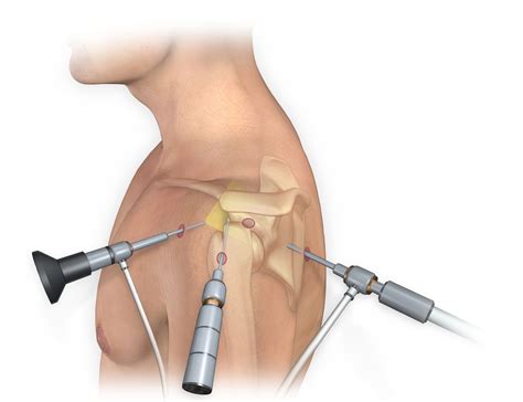 What You Should Know About Arthroscopy Surgery