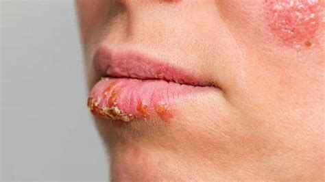 Dalam Kondisi Seperti Ini Penderita Herpes Harus Segera Lakukan