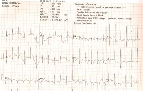 Patent Ductus Arteriosus Kauvery Hospital