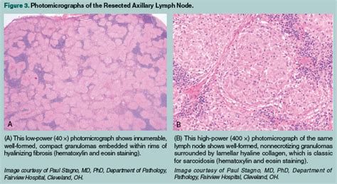 Sarcoidosis Presenting As Symptomatic Hypercalcemia In An Octogenarian