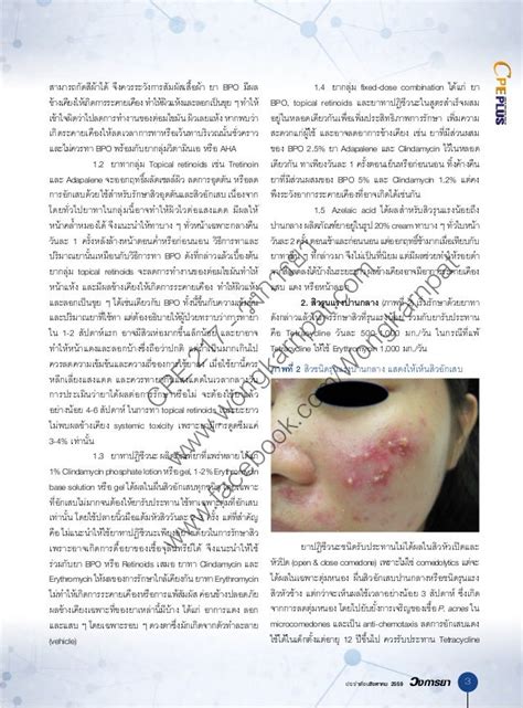 Acne vulgaris treatment & management