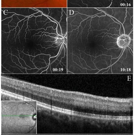 Spectral Domain Optical Coherence Tomography Angiography Sd Oct A