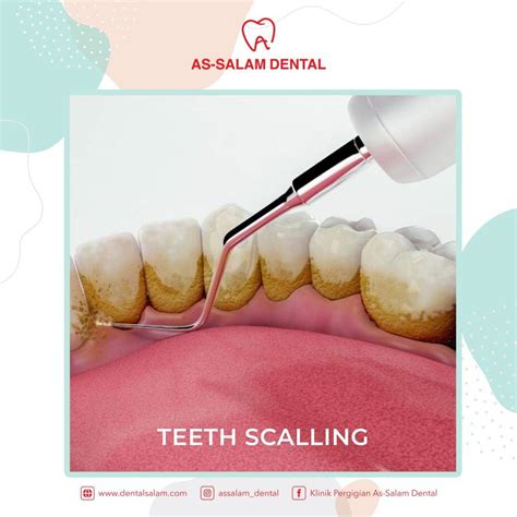 DO YOU KNOW WHAT SCALING As Salam Dental