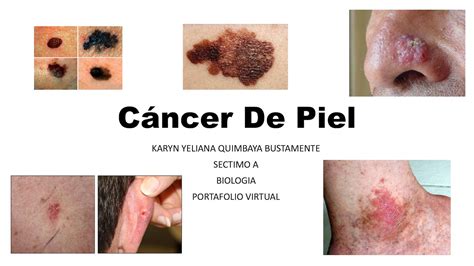 Calaméo Cáncer De Piel