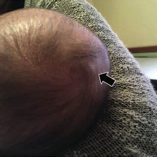 -Visible head lump on the right parietal region. | Download Scientific ...