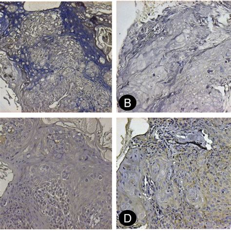 In Situ Hybridization Analysis Of Mir 21 Staining In Tumor Cells A