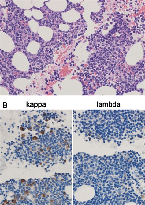 Figure3the Bone Marrow Histology Clot Section A A Bone Marrow