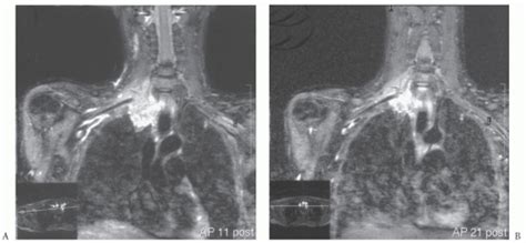 Resection of Superior Sulcus Tumors | Thoracic Key