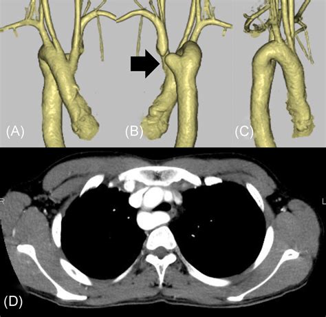 Preoperative Threedimensional Computed Tomography A Front View B