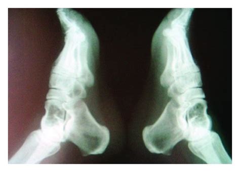 A Lateral Radiographs Of Bilateral Ankles Showed Multiple Lytic Download Scientific Diagram