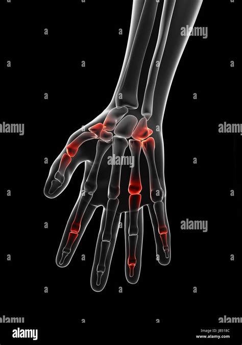 Inflammation Of Joints Stock Photos & Inflammation Of Joints Stock ...