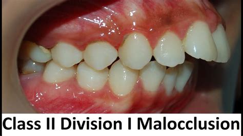 Can Class Ii Division I Of Malocclusion Be Treated With Orthotropics By