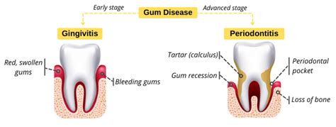 Gingivitis Vs Periodontitis Share Dental Care