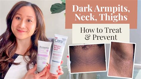 Treating And Preventing Dark Armpits Thighs Neck And Arms Dr