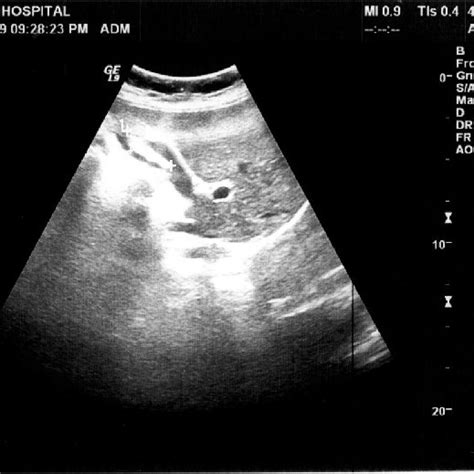 Abdominal Ultrasonography Showing Homogenous Fatty Liver Download