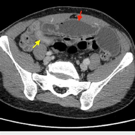 Ct Abdomen And Pelvis Demonstrating The Thickened Segment Of Ileum