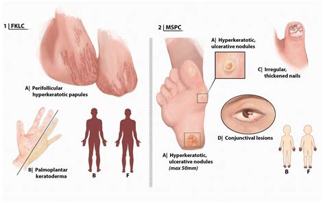 Cutaneous Signs And Mechanisms Of Inflammasomopathies Annals Of The