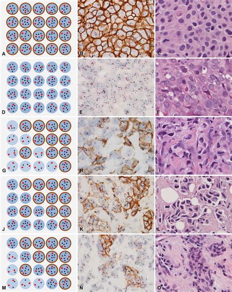 Demonstration Of Five HER2 Staining Patterns Of HER2 Positive Breast