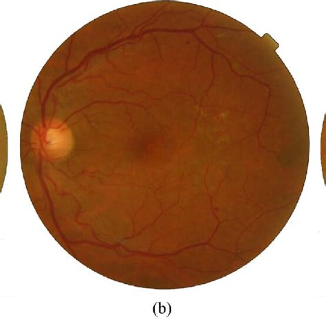 Photographs Of Different Phases Of Diabetic Macular Edema A Healthy Download Scientific